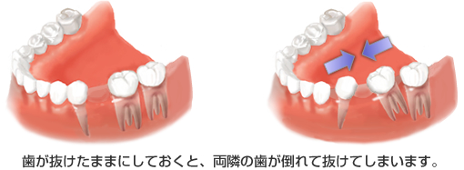 歯を抜けたままにした例