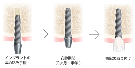 インプラントの埋入