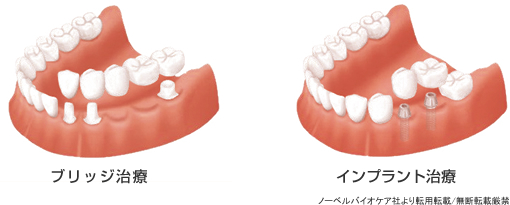 ブリッジ治療との比較