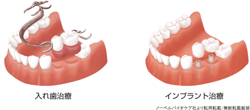 入れ歯治療との比較
