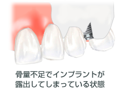 骨量不足でインプラントが露出