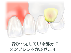骨が不足している部分にメンブレンをかぶせる