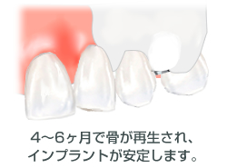 骨が再生されインプラントが安定