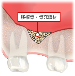 骨補填材を詰めて骨そ再生させる