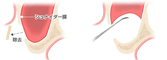 上顎洞底部と歯槽骨の間の粘膜（シュナイダー膜）を持ち上げて隙間
