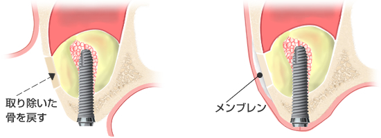 平たくつぶしたCGF（完全自己血液由来のフィブリンゲル）メンブレンを人工のメンブレンの代わりに被せて縫合