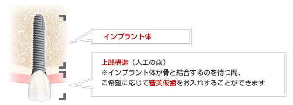 インプラント治療の料金