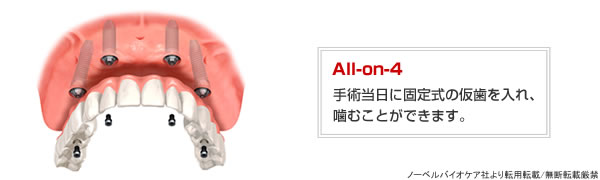 All-on-4