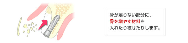 骨を増やすインプラント治療